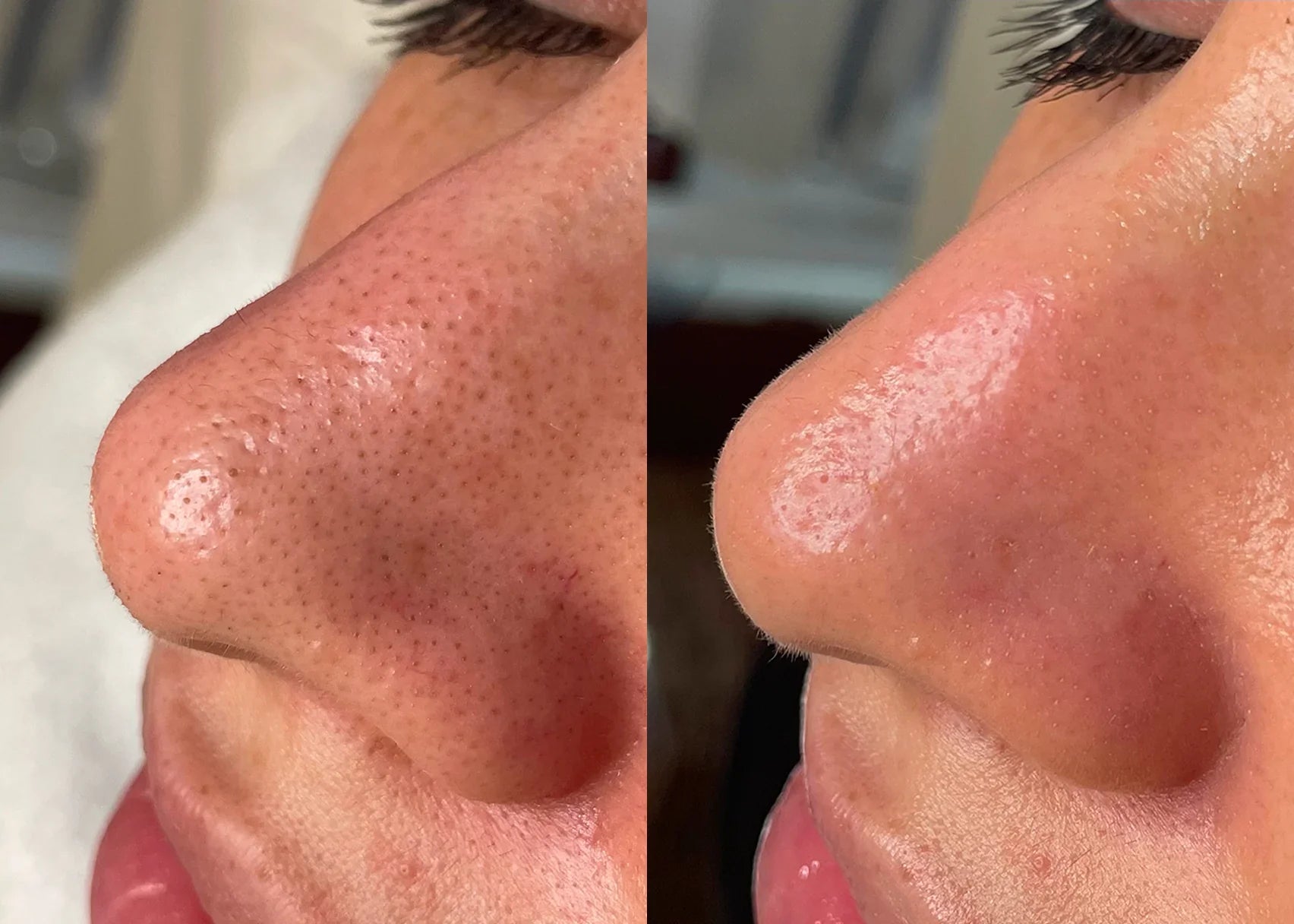 HydraFacial Glow Results