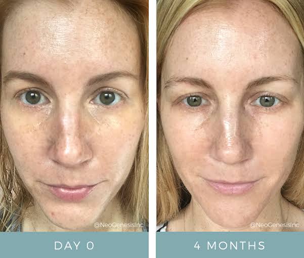 Pigmentation Recovery Story