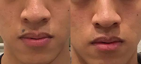 Mole Removal Success Story