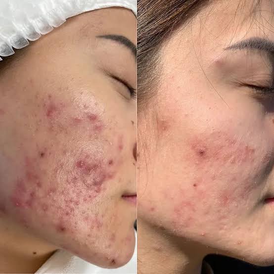 Acne to Clear Skin Journey