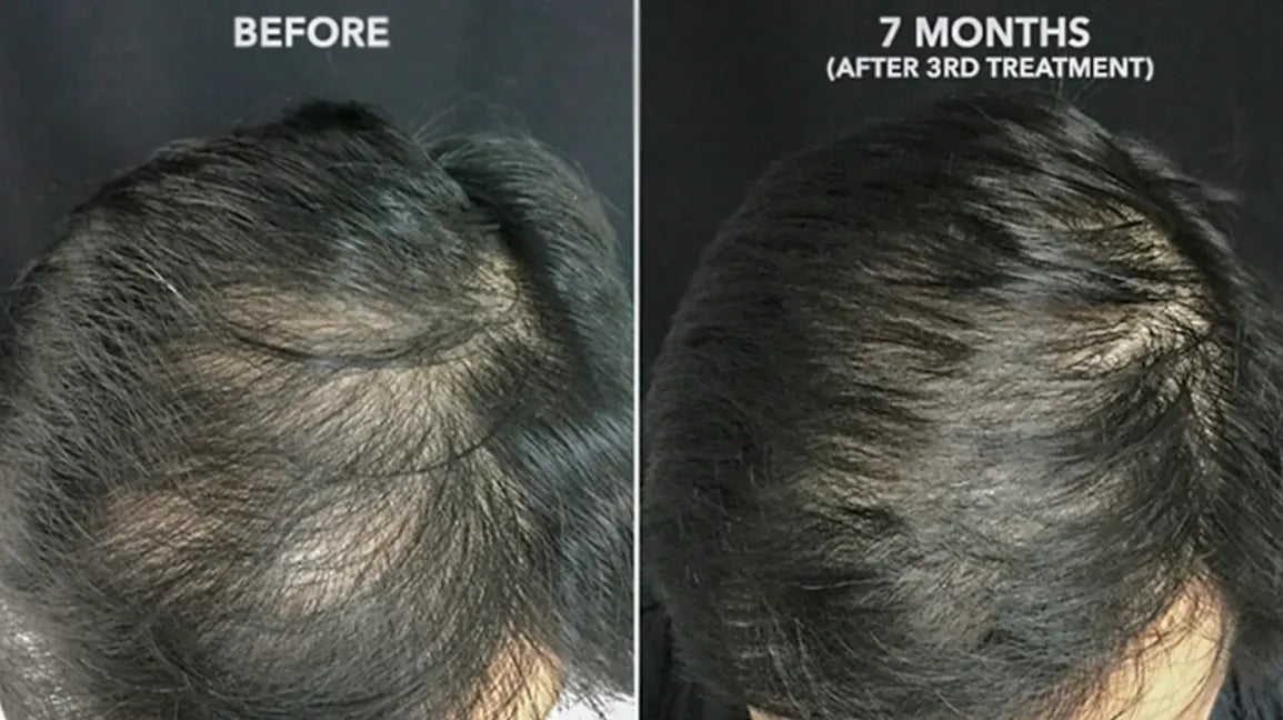 PRP Hair Therapy Results